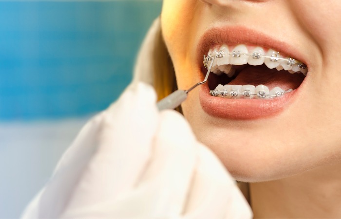 Dental Braces